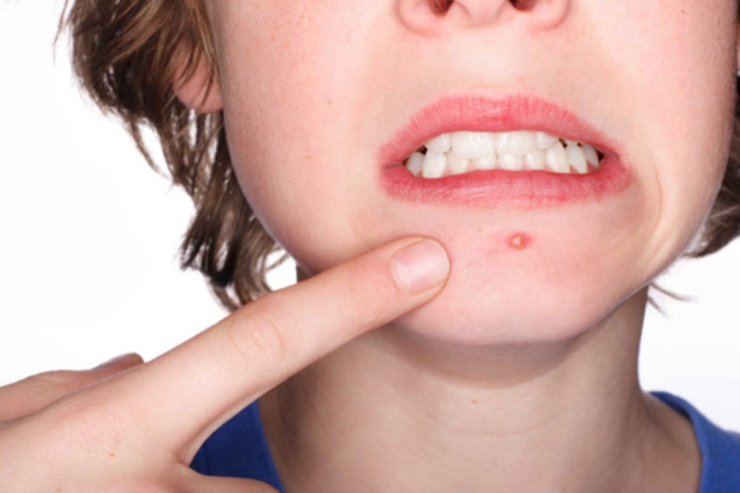 Cách điều trị mụn trứng cá thể nhẹ