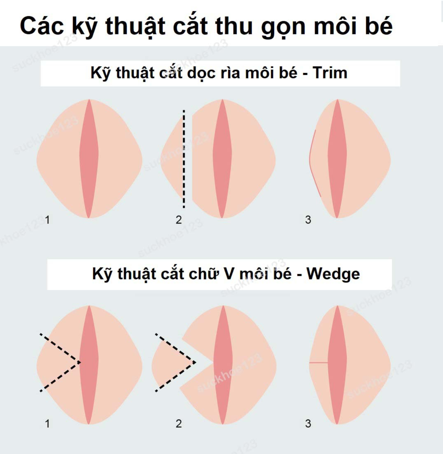 ky thuat cat moi be