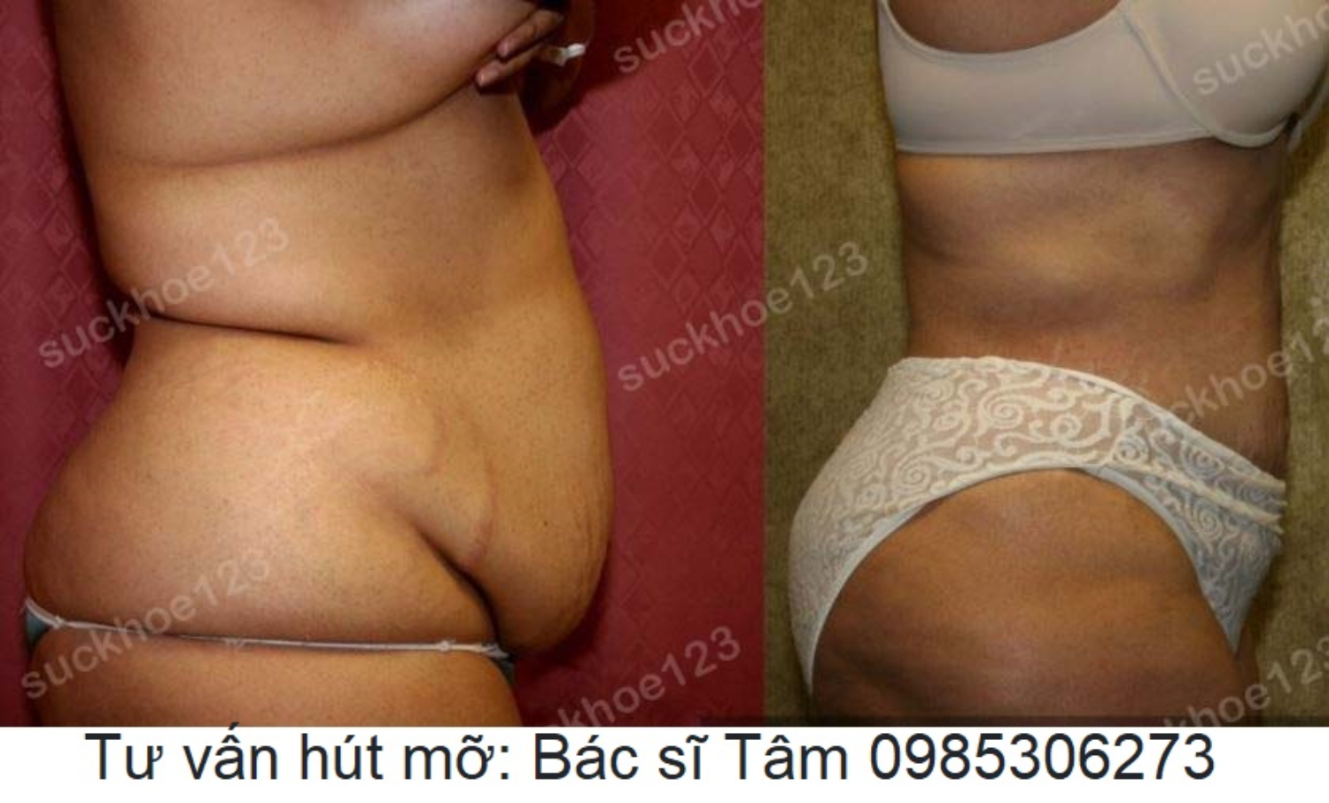 hut mo bac si tam ca 22 3