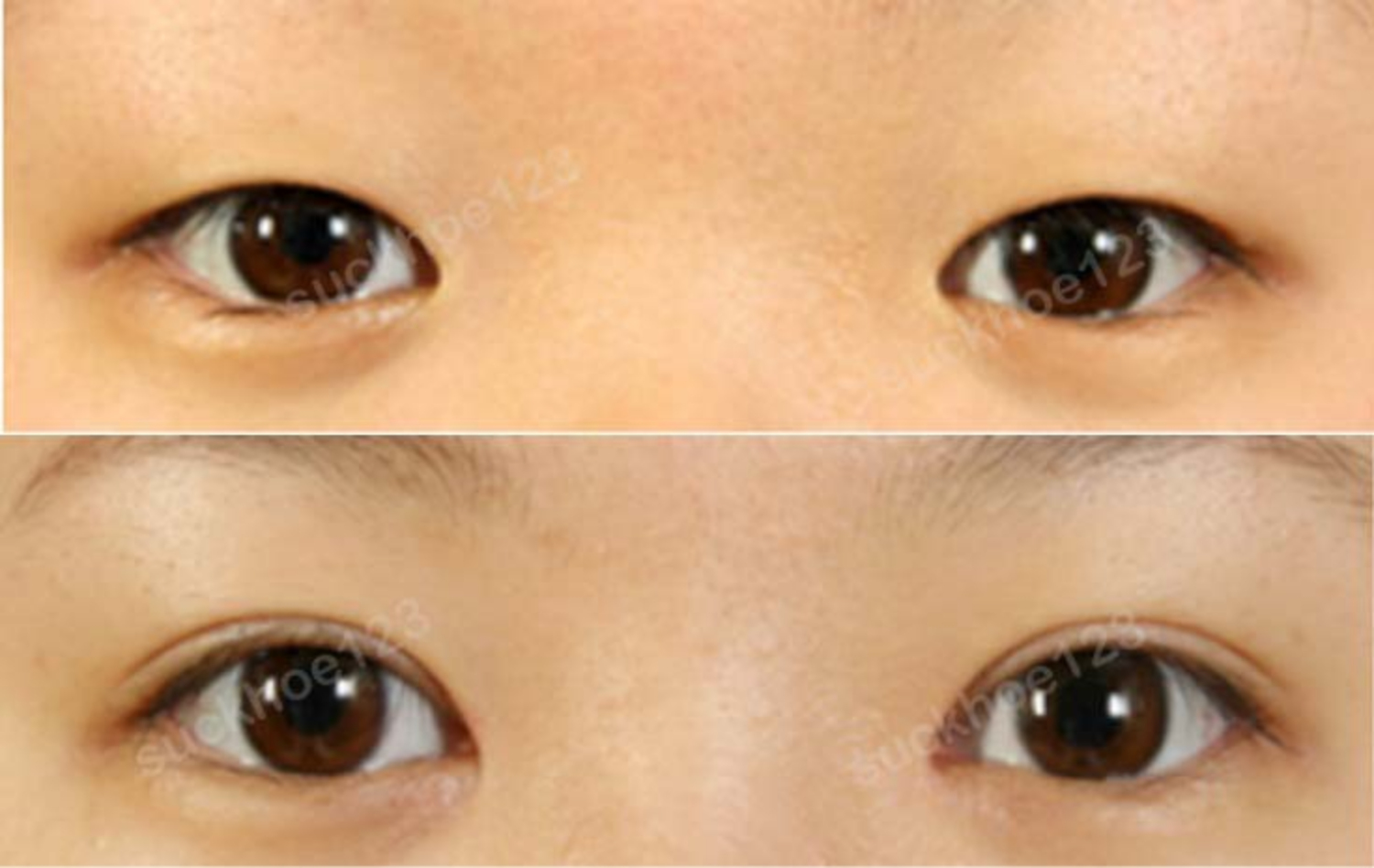 mo goc mat trong khac phuc goc mat xa nhau