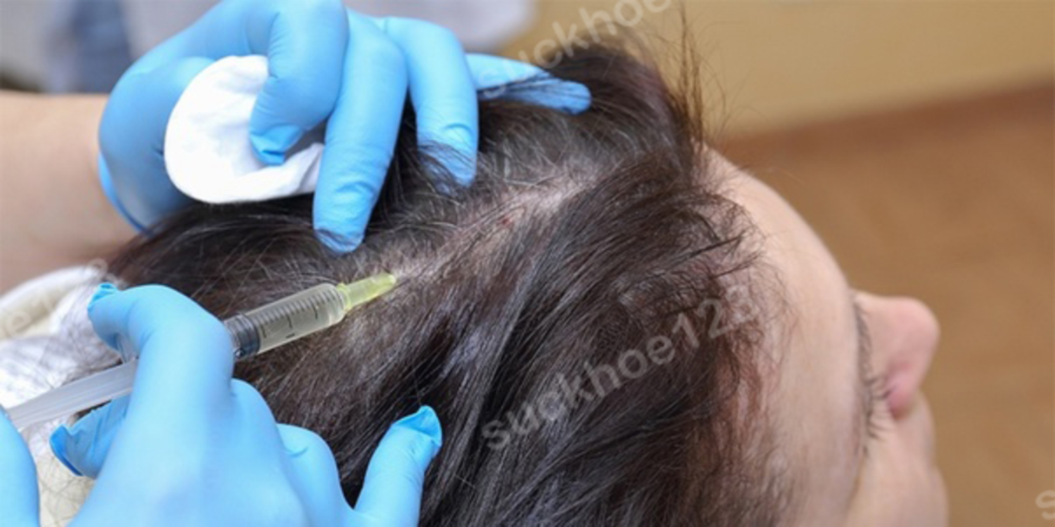tiêm PRP trị rụng tóc