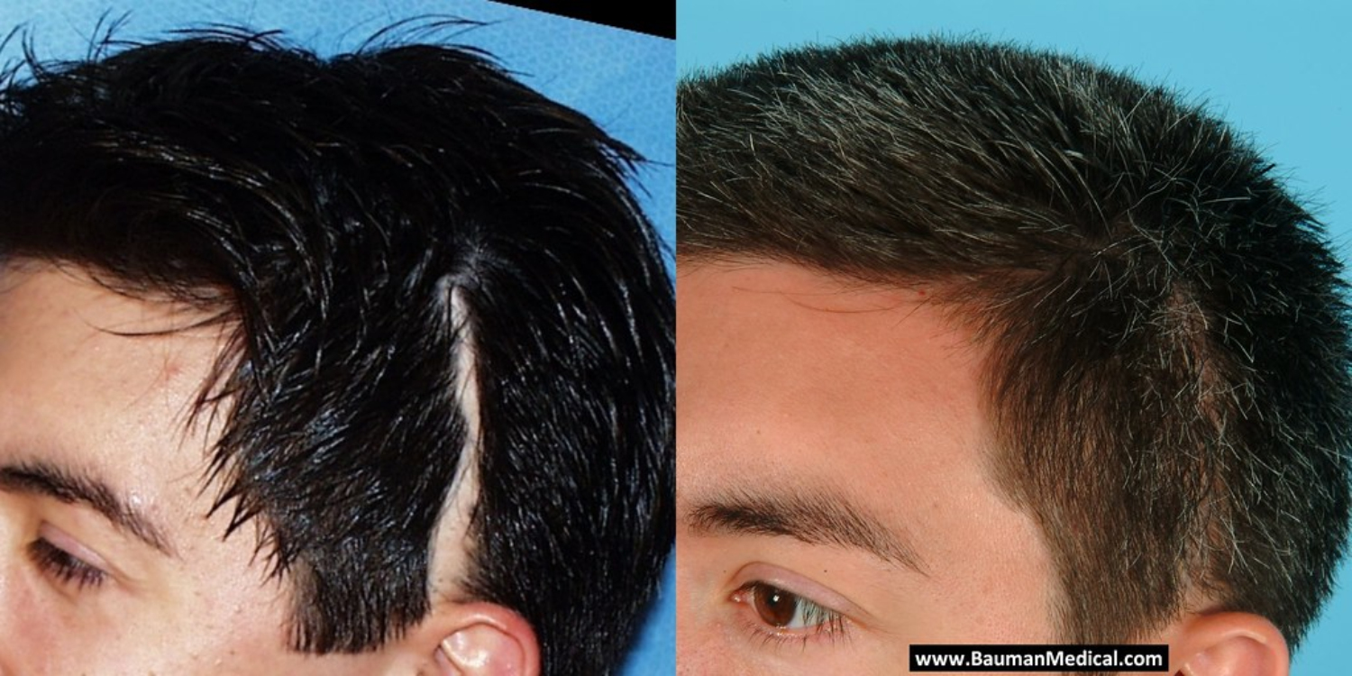 Cấy tóc vào vết sẹo trên da đầu có được không, hiệu quả mức nào?