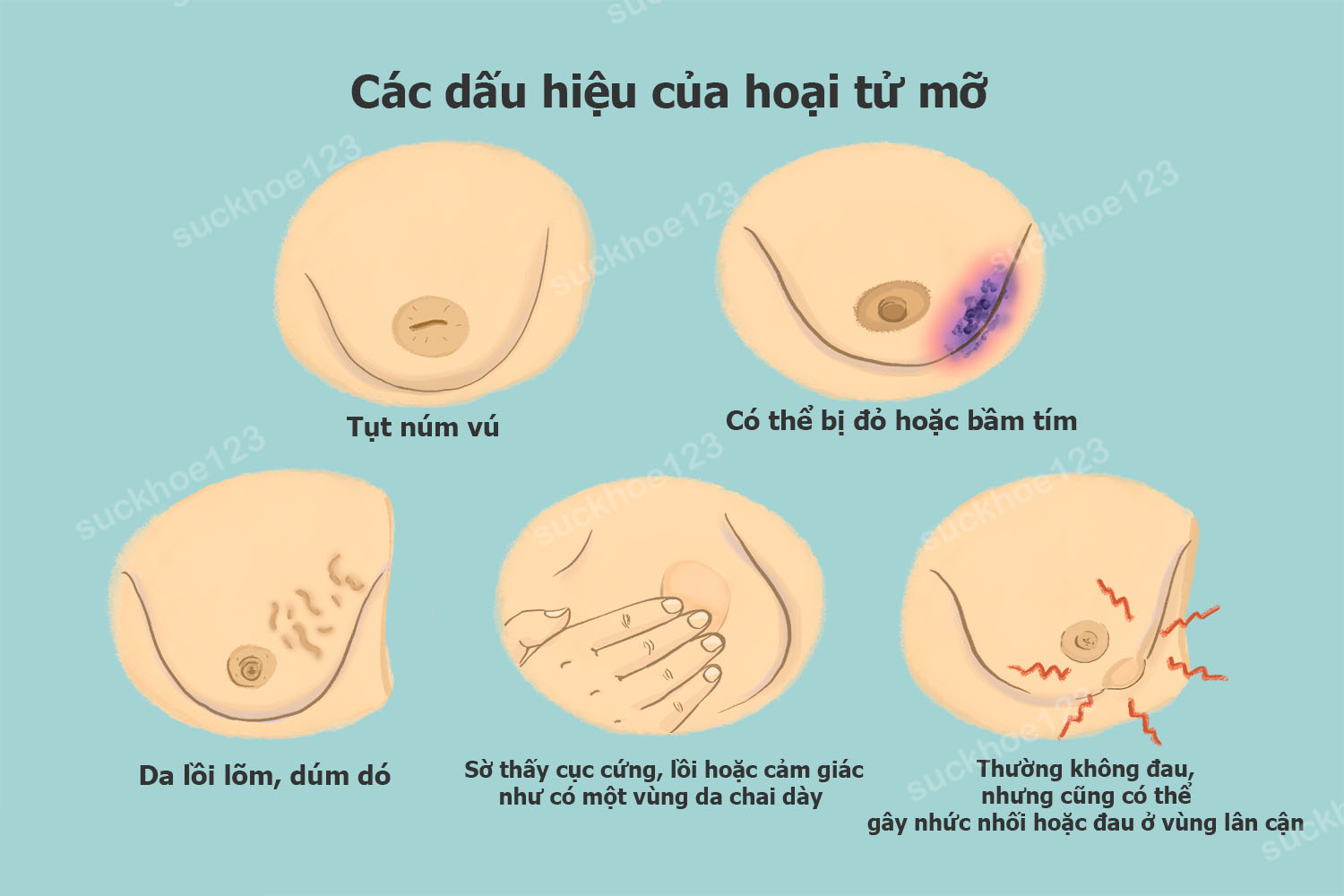 Hoại tử mỡ do phẫu thuật thu nhỏ ngực