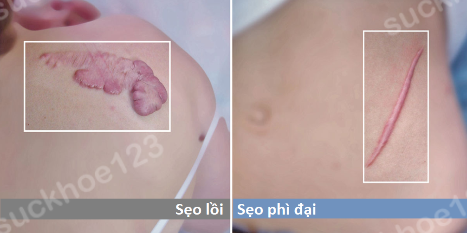 sẹo lồi và phì đại