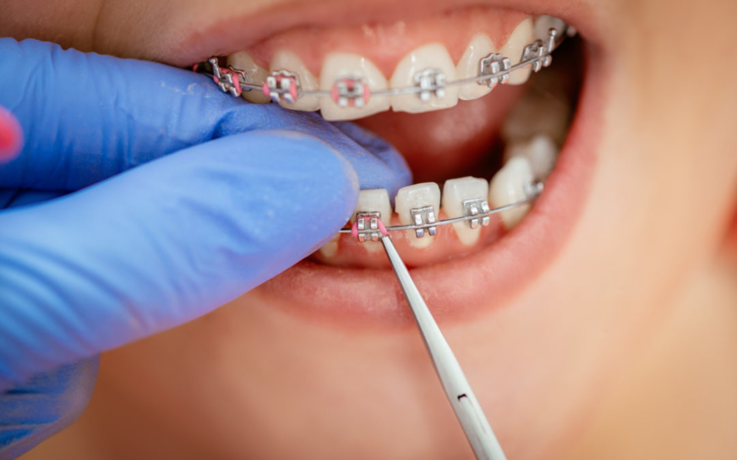 Phù thủy niềng răng trả lời xử trí răng hô, vẩu, lẹm cằm như thế nào?