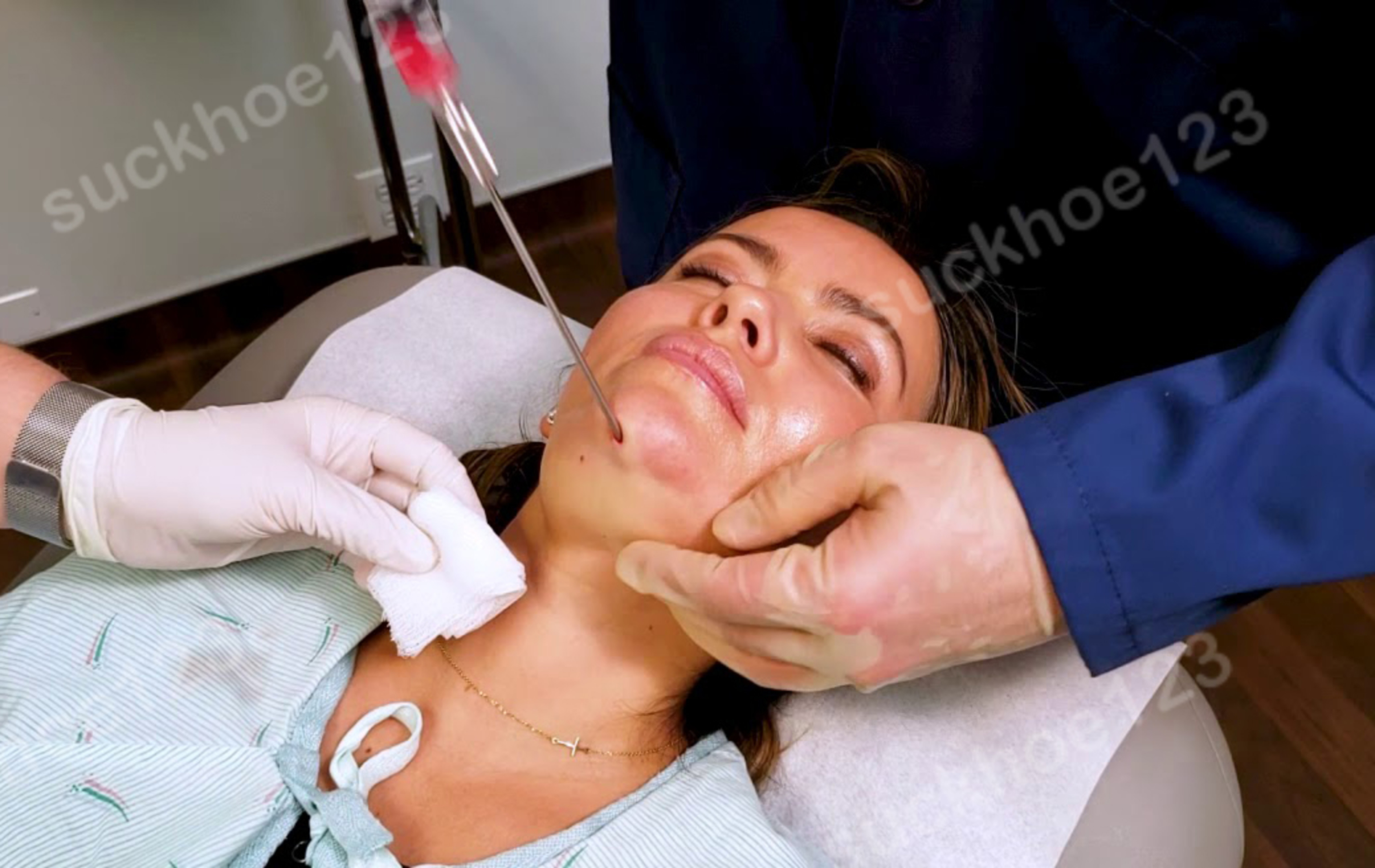 hút mỡ cổ