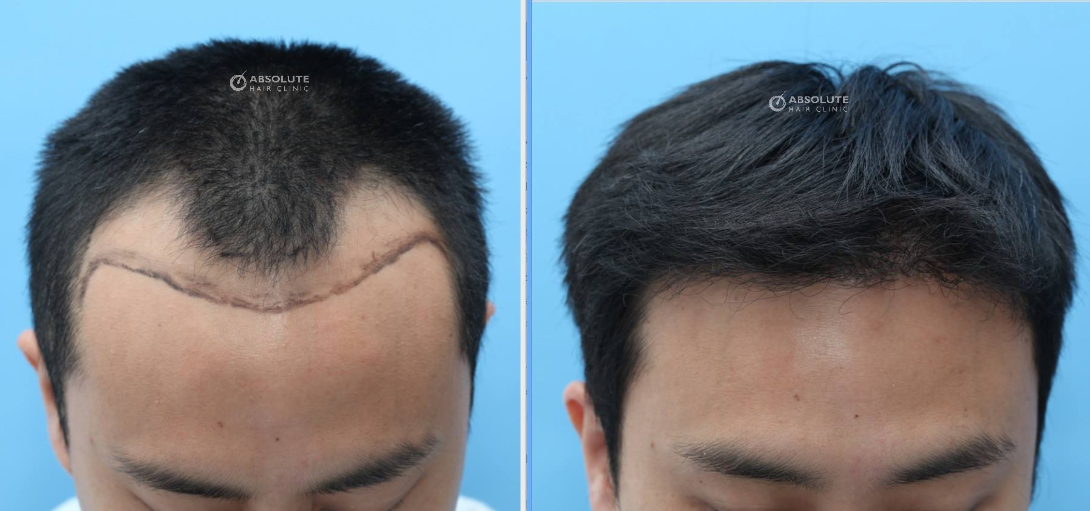 Hướng dẫn chăm sóc sau cấy tóc tự thân