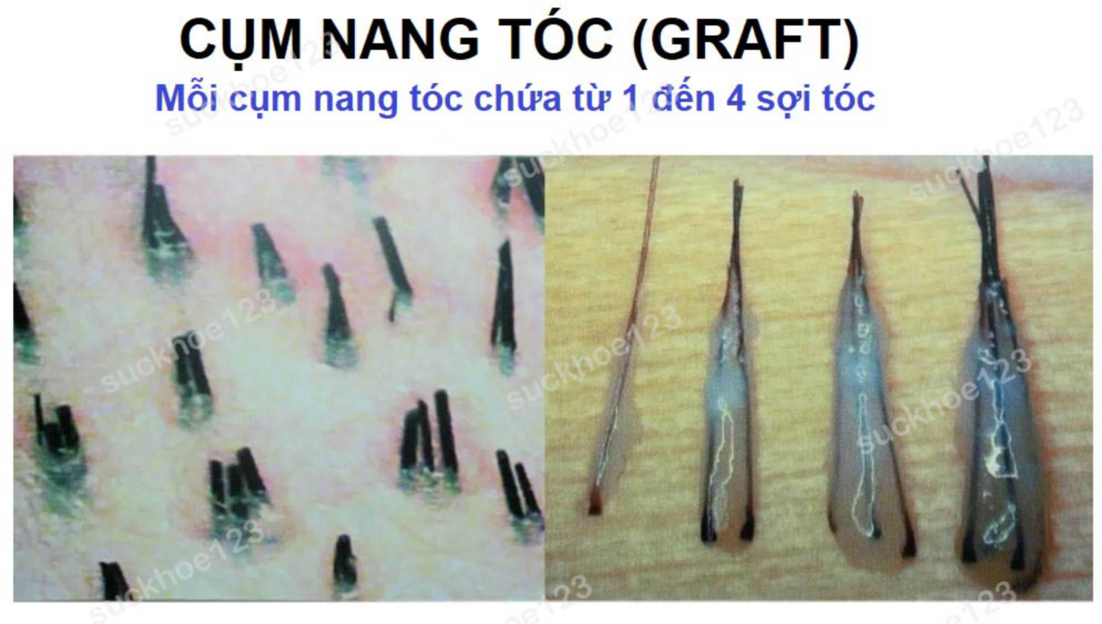 Phân biệt nang tóc – sợi tóc – cụm nang tóc