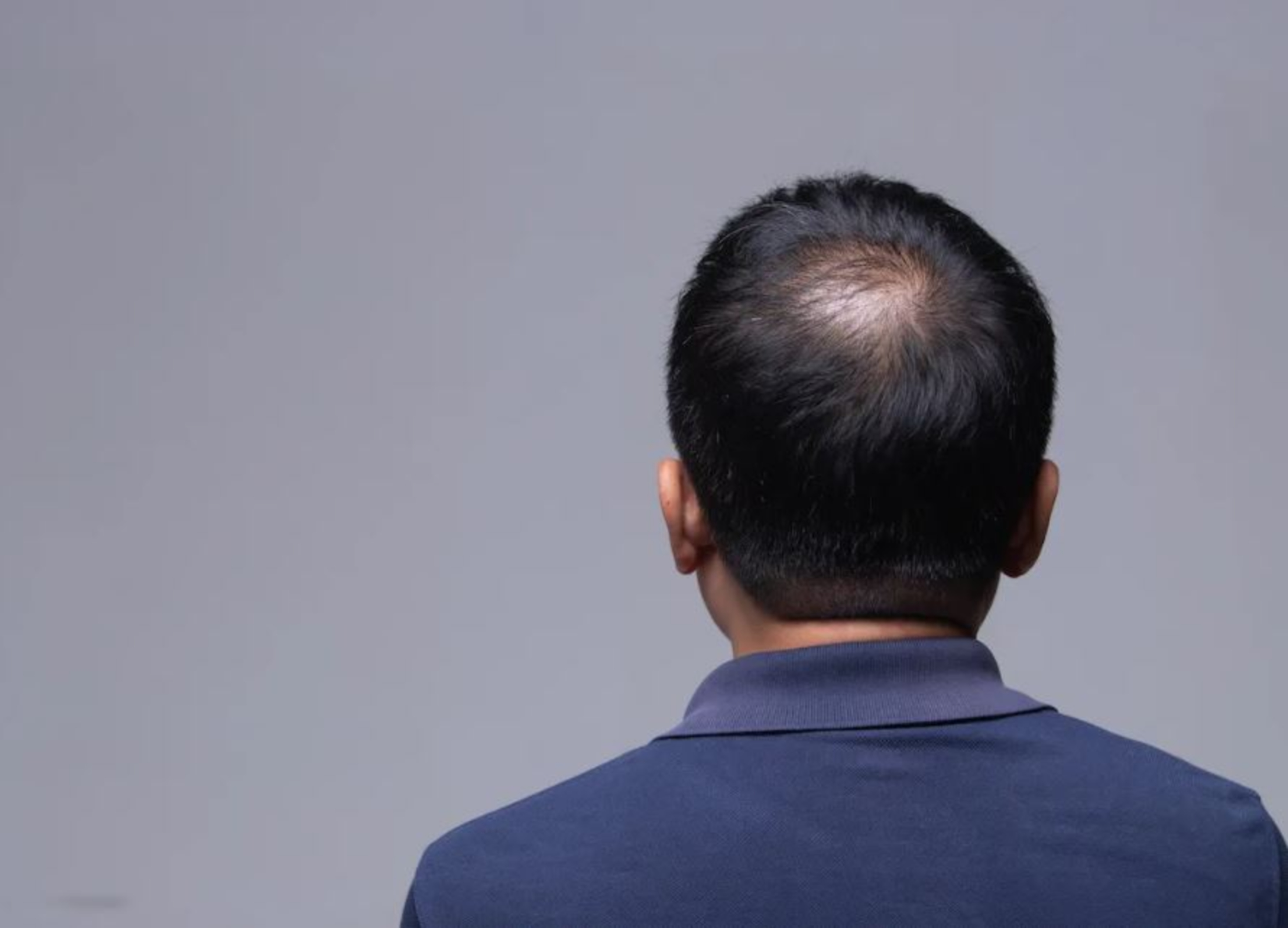Hói Đỉnh Đầu: Nguyên Nhân Và Cách Điều Trị