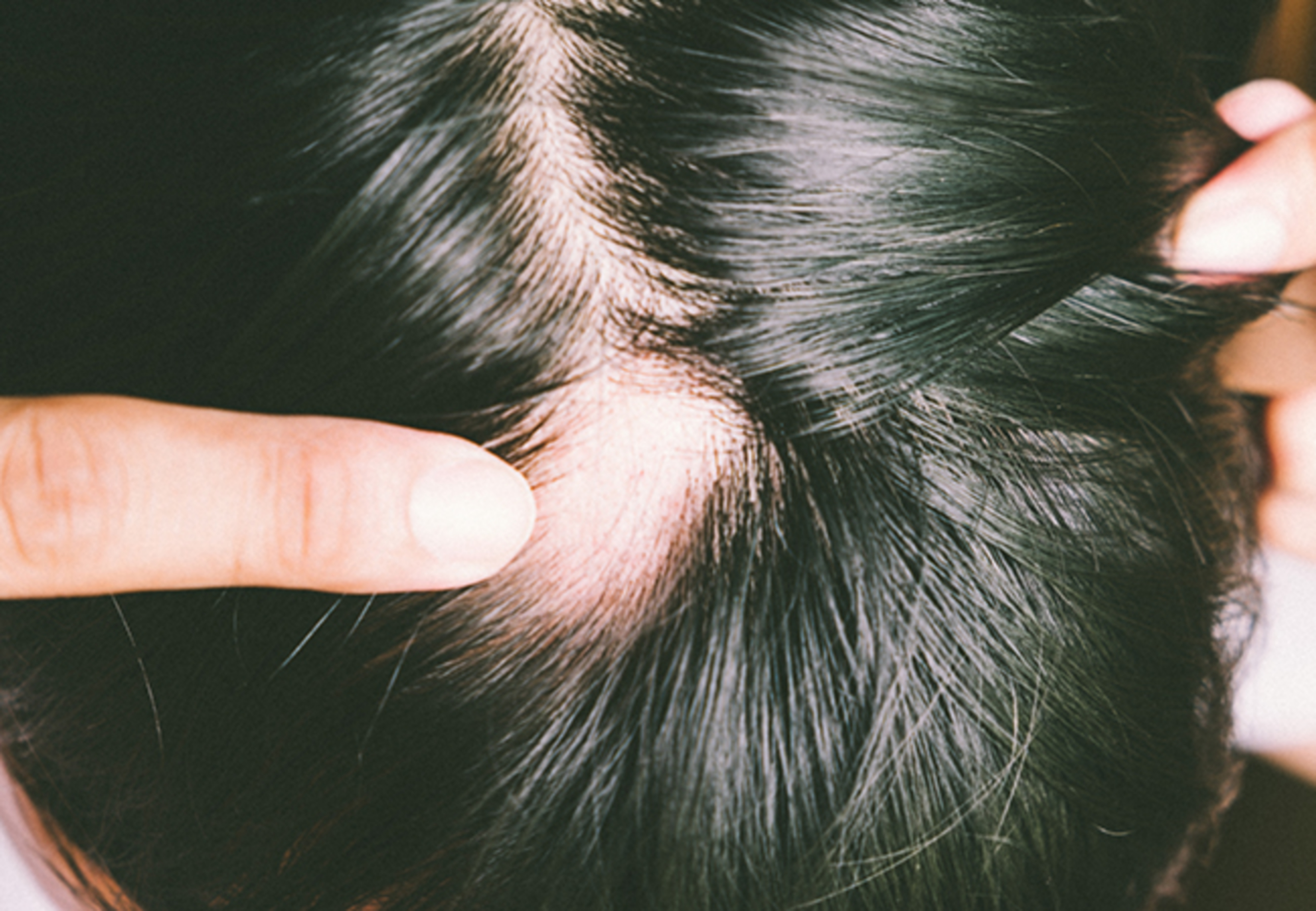 Rụng tóc từng mảng: Nguyên nhân và cách điều trị