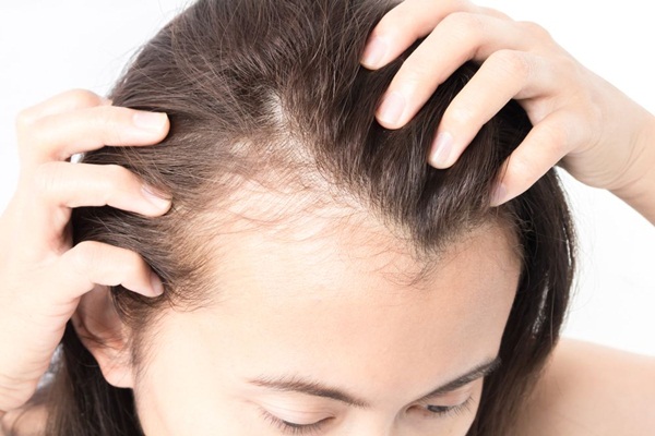 Giảm cân không đúng cách có thể gây rụng tóc và hói đầu