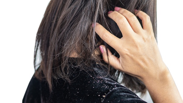 Bị gàu có nên sử dụng dầu xả không?