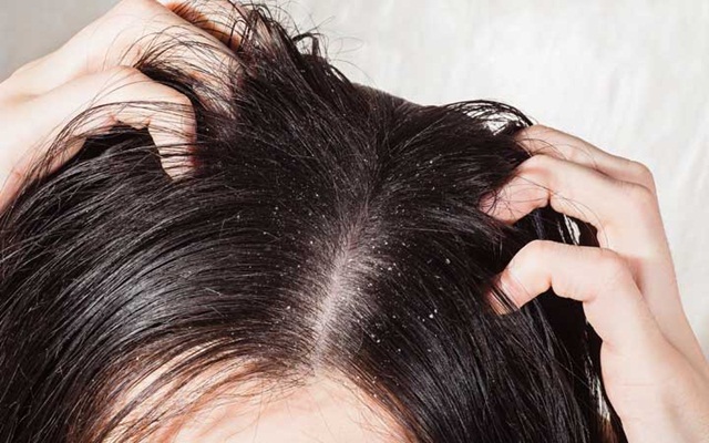 Làm thế nào để giảm và ngăn ngừa gàu?