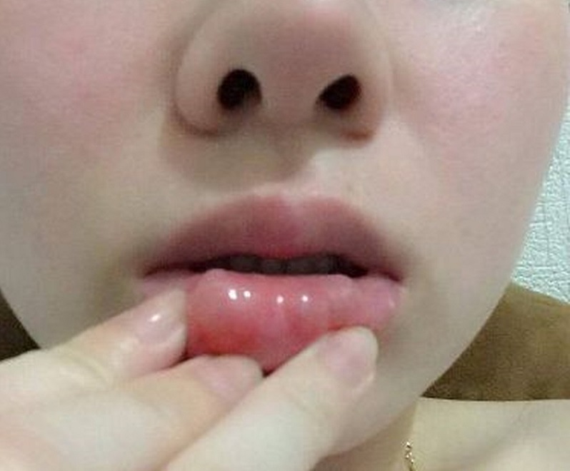tiêm filler bị sưng