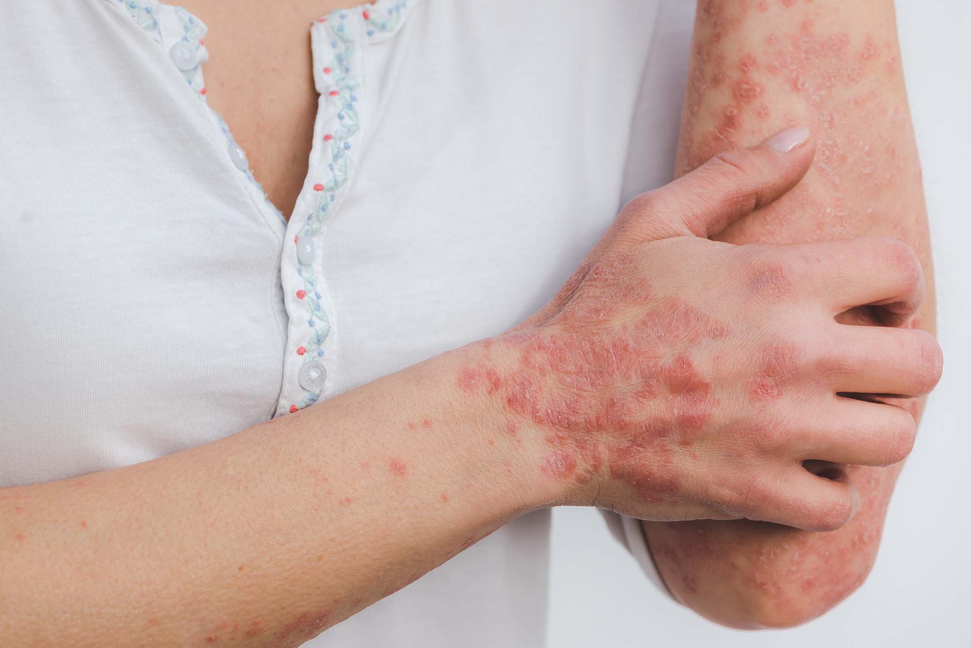Những Điều Cần Biết Về Bệnh Vảy Nến