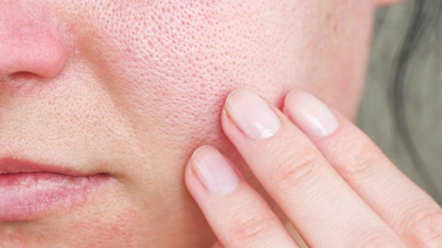 Nguyên Nhân Gây Bít Tắc Lỗ Chân Lông Và Mụn Trứng Cá Không Viêm