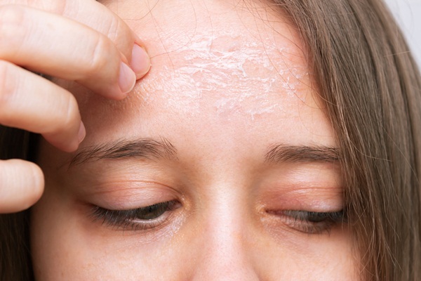 Thói Quen Chăm Sóc Khi Bị Bệnh Vảy Nến