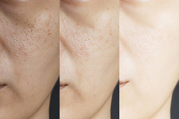 Hydroquinone – Một Trong Những Thành Phần Làm Sáng Da Hiệu Quả Nhất
