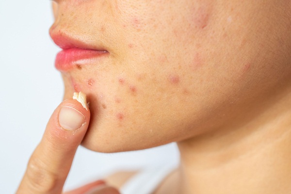 Mất Bao Lâu Để Trị Khỏi Mụn Trứng Cá?