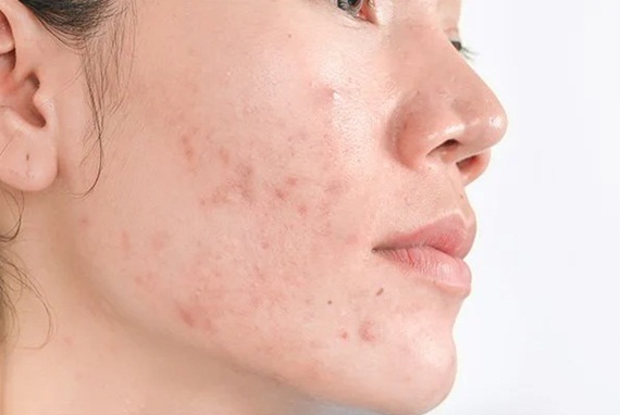 Nguyên Nhân Và Điều Trị Tăng Sắc Tố Sau Viêm