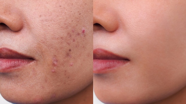 Tăng Sắc Tố Da: Nguyên Nhân Và Cách Điều Trị