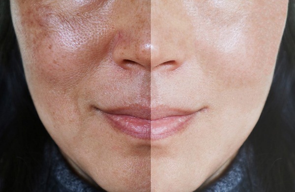 Trị Nám Bằng Chu Kỳ Chăm Sóc Da Hai Giai Đoạn