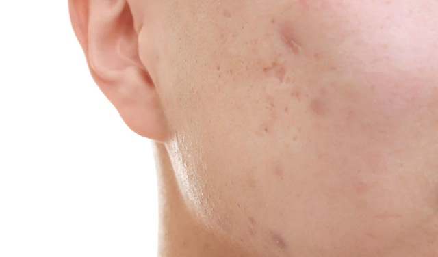 Mất bao lâu để các vết thâm trên da biến mất?