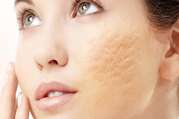 Sẹo Rỗ Và Cách Điều Trị Sẹo Rỗ