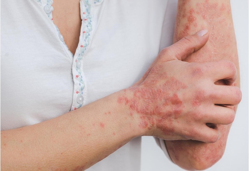 Nguyên Nhân Và Điều Trị Tăng Sắc Tố Da Ở Tay