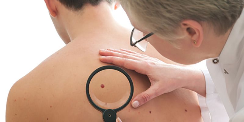 3 loại ung thư da và các dấu hiệu cảnh báo