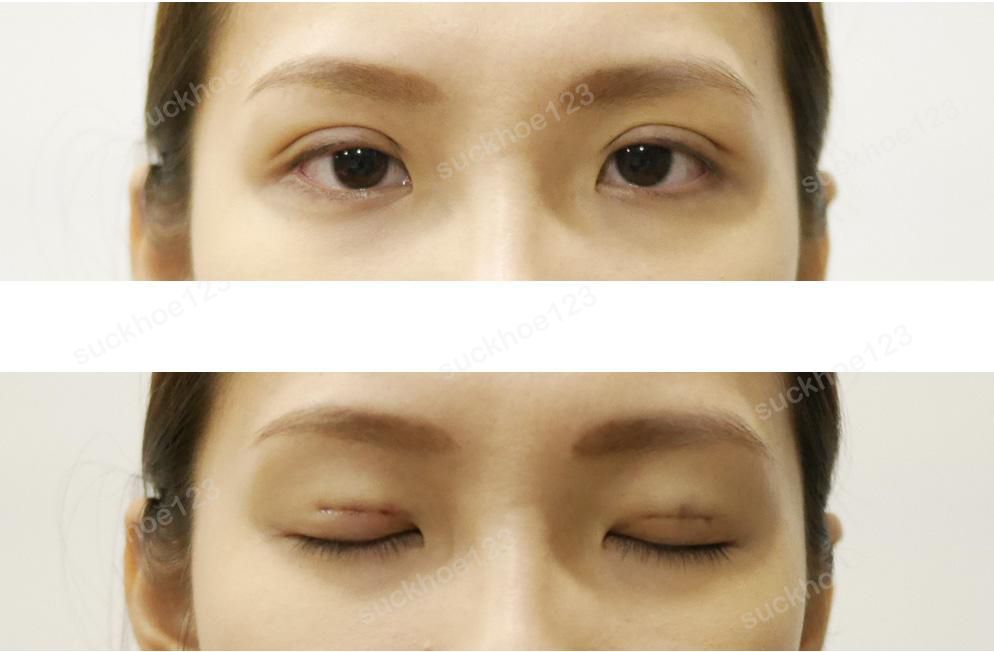 Bấm mí và 5 yếu tố quyết định đến thời gian duy trì kết quả