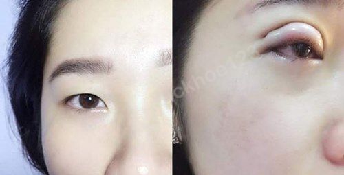 Cắt mí hỏng: lưu ý khi chỉnh sửa