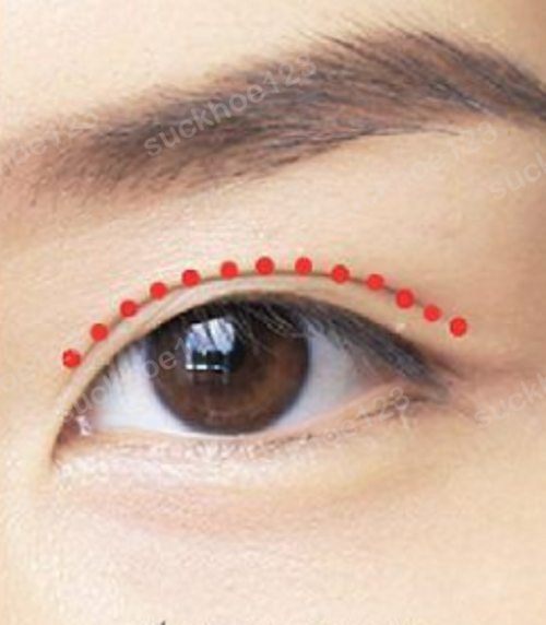 Mắt to đẹp, bền lâu với công nghệ bấm mí đa điểm (Multi Point)