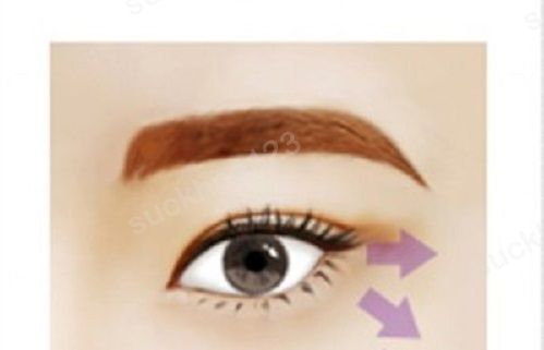 Kích mắt dài bằng phẫu thuật mở góc mắt ngoài: nên hay không?