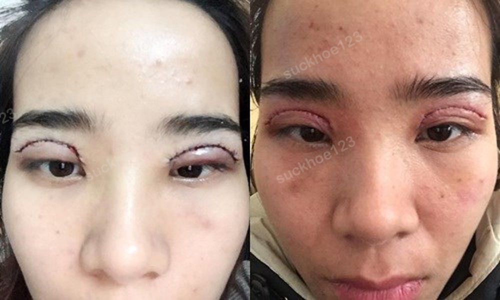 Biến chứng sau cắt mí, hãy coi chừng!