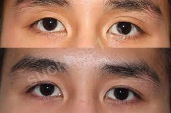 Cắt mí ở nam giới, có gì khác biệt?