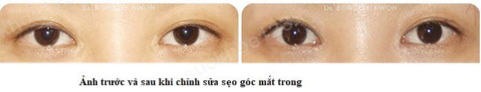 Các biến chứng sau mở góc mắt trong