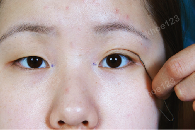 Những biến chứng sau bấm mí luồn chỉ có thể gặp phải