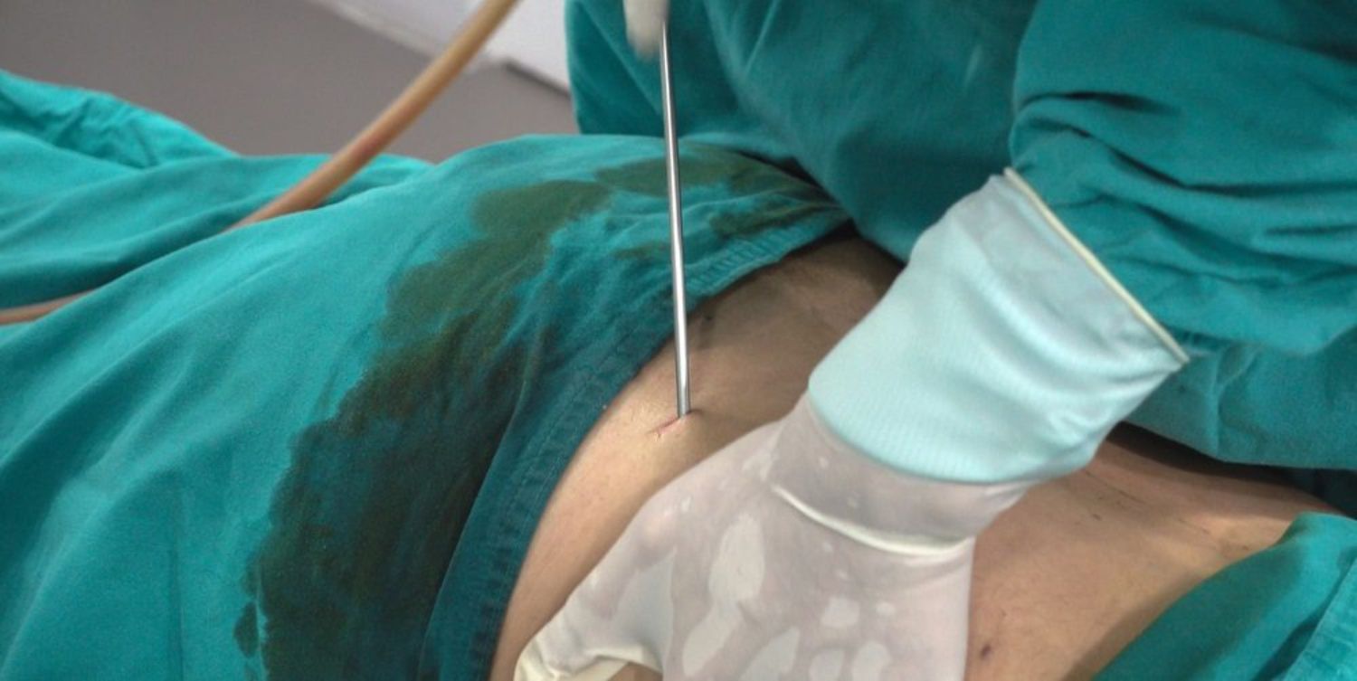 Những biến chứng có thể gặp phải sau hút mỡ