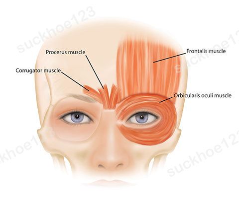 Ngăn ngừa và xử lý biến chứng sa sụp chân mày, sụp mí sau tiêm Botox