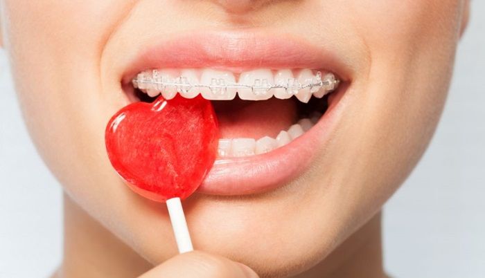 Tại sao không nên ăn đồ ngọt trong quá trình chỉnh nha?