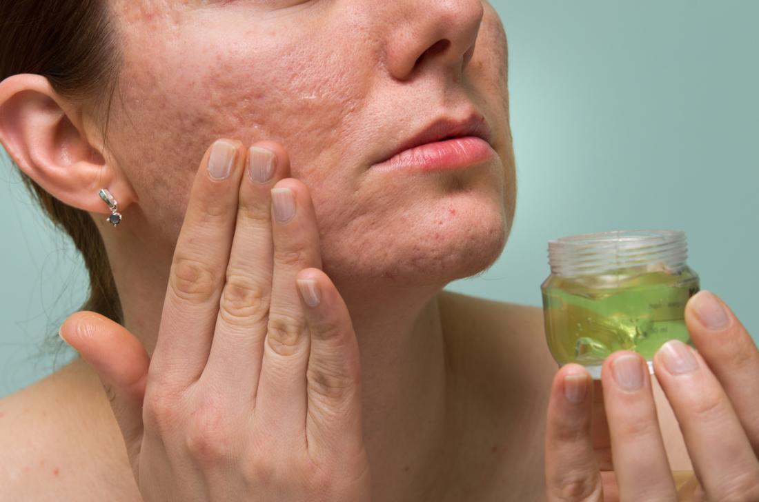 Giới thiệu các cách trị mụn