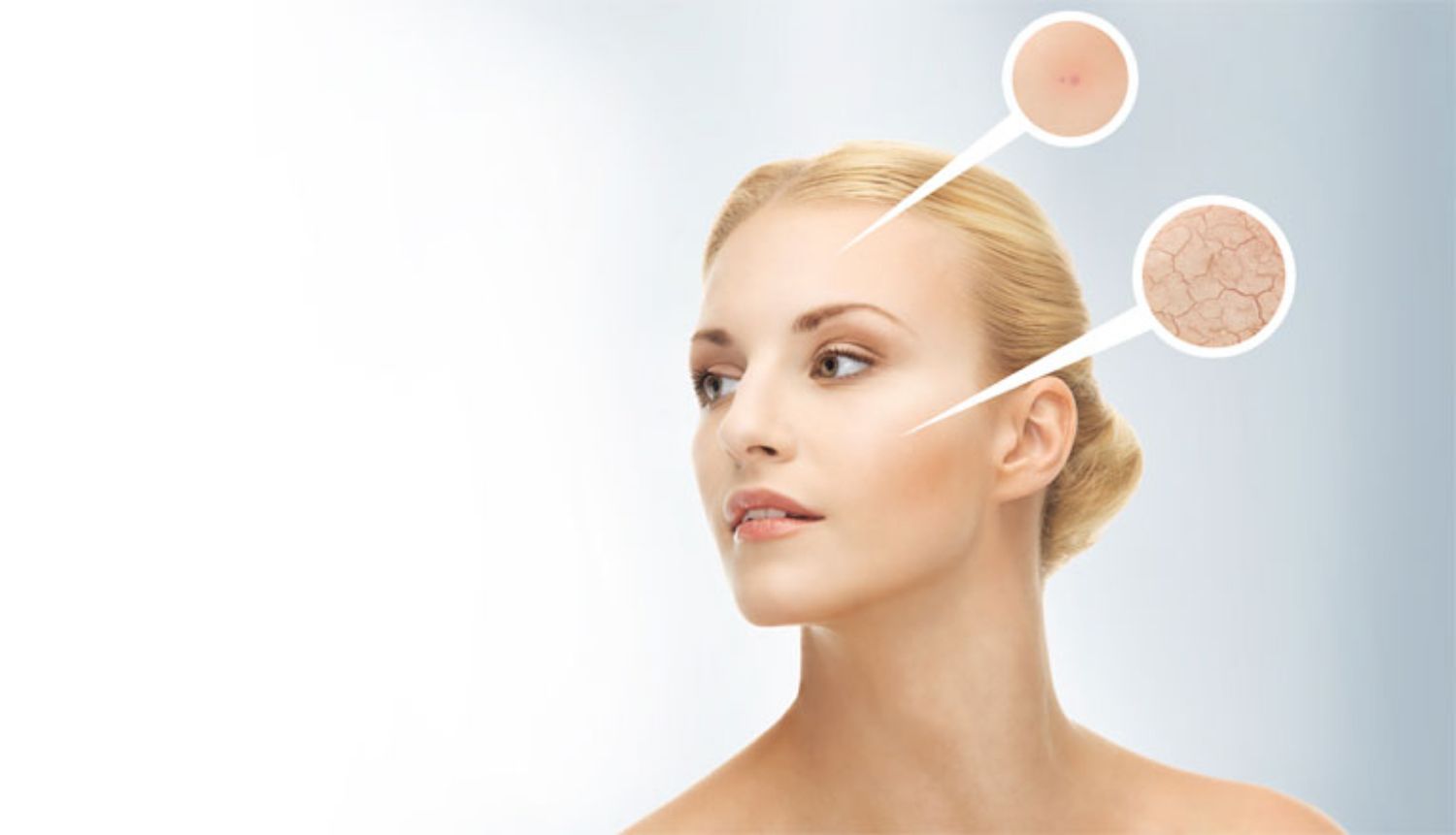 Các giải pháp hiệu quả cho da dễ bị mụn