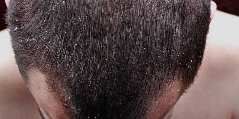 Hướng dẫn cách trị gàu - Dr Bauman