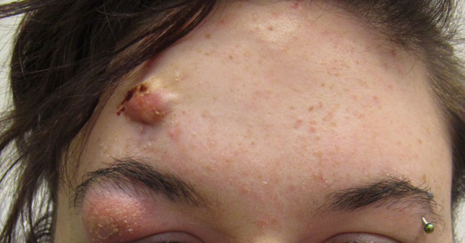 Cách trị mụn bọc