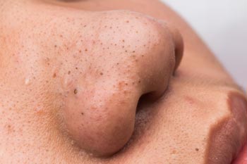 Mụn đầu đen và nguyên nhân gây mụn