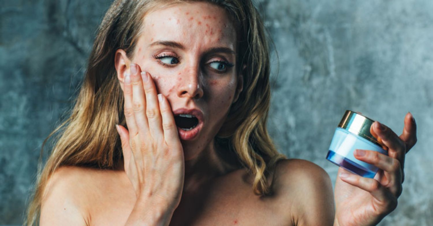 Cách loại bỏ mụn thâm