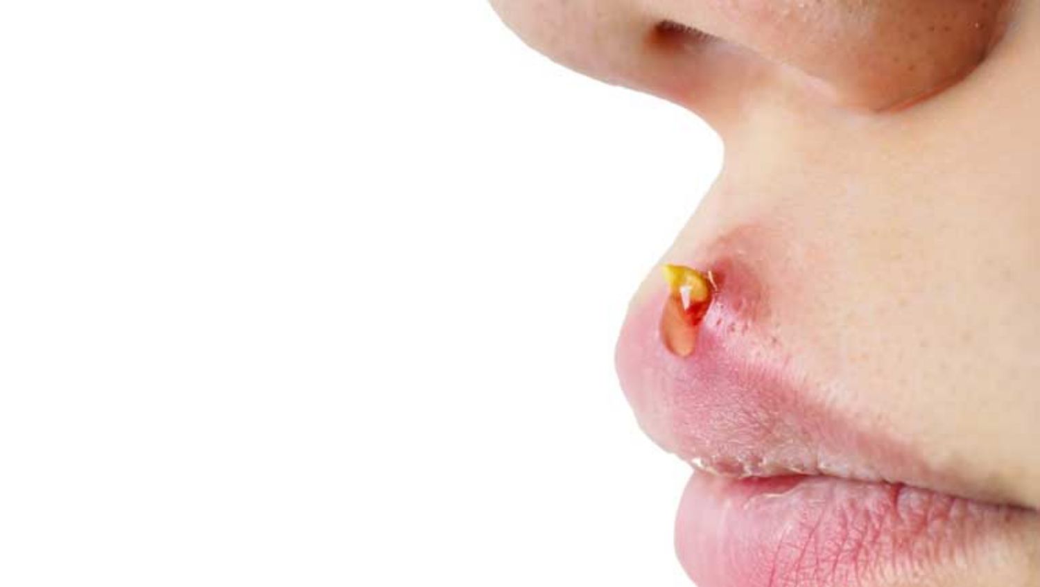 Các mẹo và phương pháp trị mụn trứng cá vùng miệng