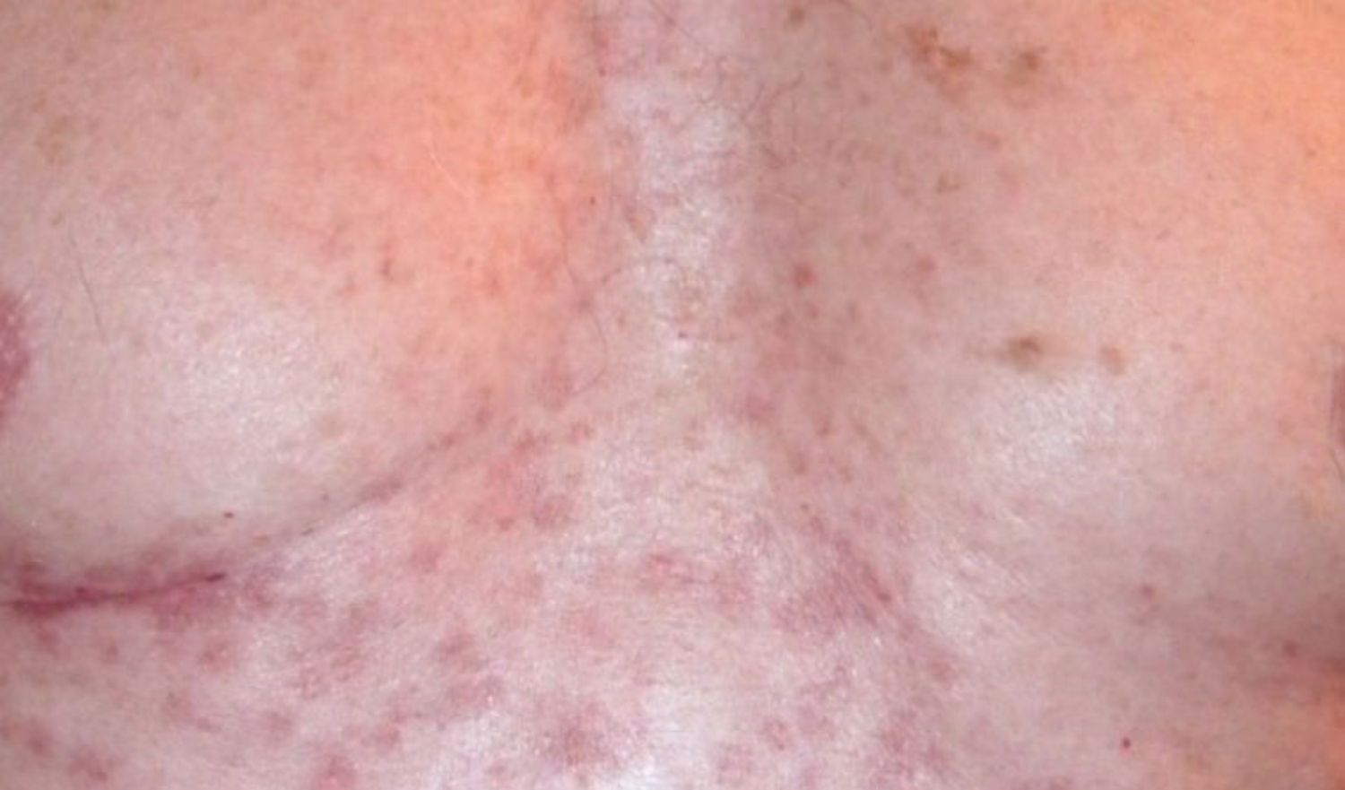 Cách trị mụn trứng cá ở vùng ngực