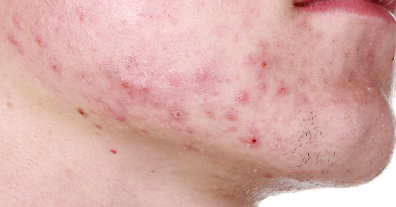 Cách trị mụn vùng quai hàm nhanh và hiệu quả